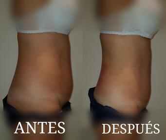 ANTES Y DESPUES DE LIPOSONIX